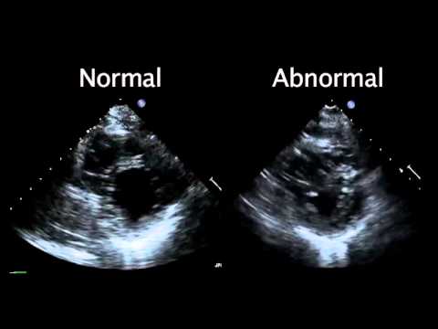 Echocardiogram From The Patient Compared With That From A Normal Control |  Nejm - Youtube